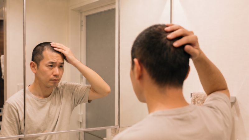 鏡を見て生え際のラインを確認する男性。AGA治療を開始する前に、自身の薄毛の進行度を客観的に把握する様子。