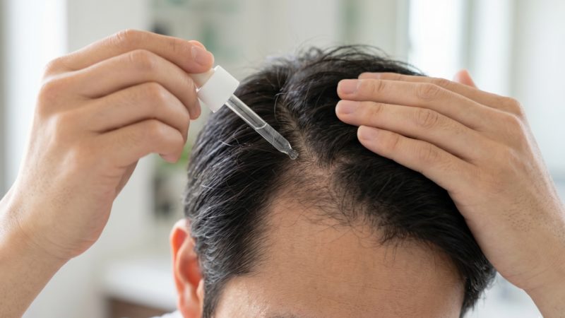 頭皮に直接塗布するタイプのAGA治療薬を使用する男性。クリニック処方の外用薬による日々の薄毛対策。