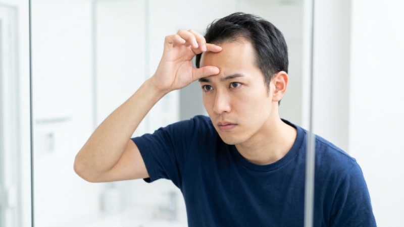 鏡を見ながら生え際の後退具合を確認する男性。AGAクリニック受診を検討する際の基準となるセルフ診断。