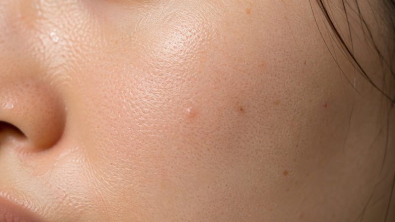 毛穴に皮脂が詰まって発生した白ニキビの状態。種類別の原因を知り、初期段階での対策やサプリ活用が重要。